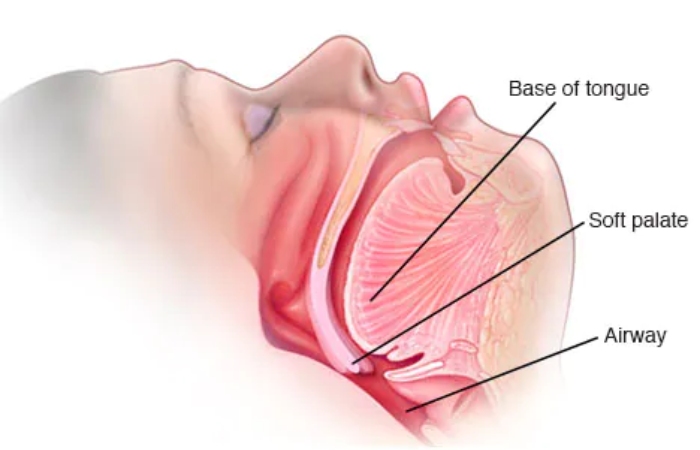 Symptoms of Snoring