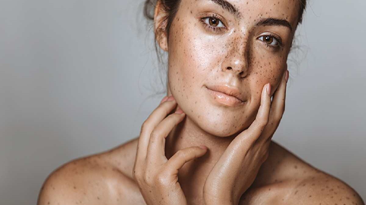 6 Tips for Managing Melasma Flare-Ups