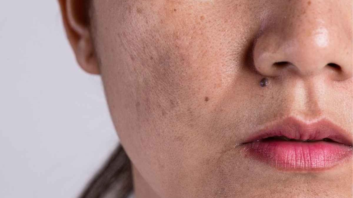 6 Tips for Managing Melasma Flare-Ups