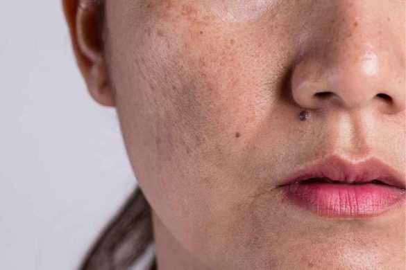 Melasma Flare-Ups